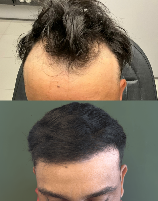 Comparativo de evolução de transplante capilar